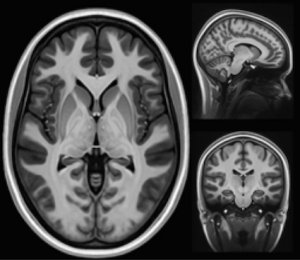Pourquoi la maladie de Charcot semble exploser, comprendre une énigme moderne